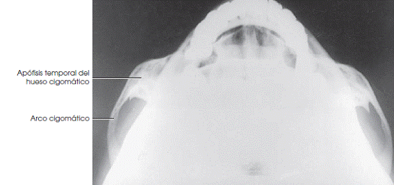 Zygomatic Arches Anatomy